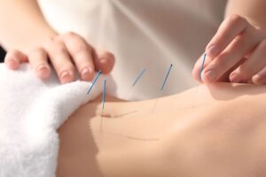 Up close view of acupuncture