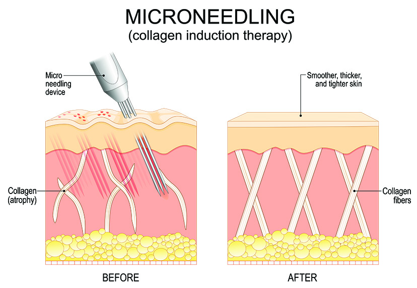 Illustration of microneedling showing before and after effects on skin structure, with increased collagen fibers and smoother, tighter skin after treatment.